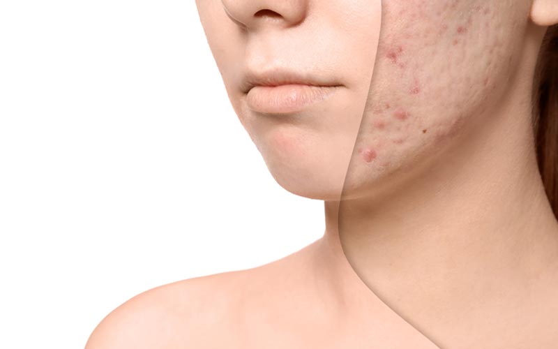 acne treatment in mohali
