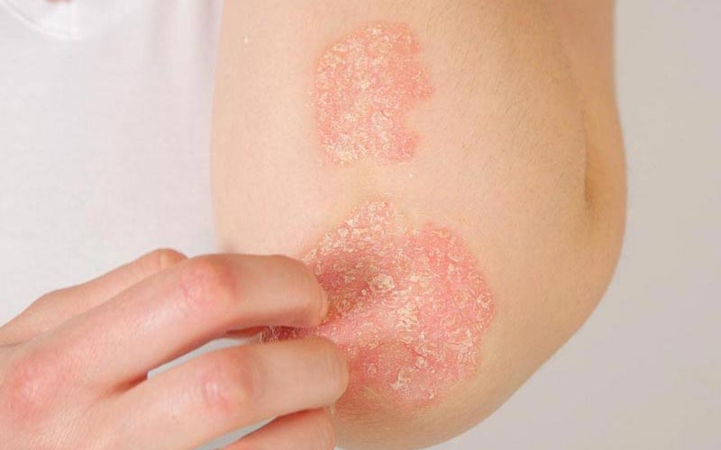 Psoriasis treatment in Mohali