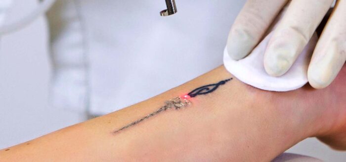 How does laser tattoo removal work? - Derick Dermatology