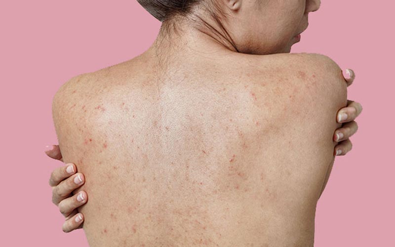 Back acne treatment in chandigarh