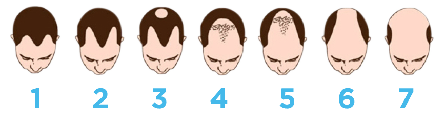 best hair transplant in mohali