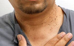 Skin Tags And Its Causes Dr Walia S Skin And Laser Clinic   Skin Tags 300x188 