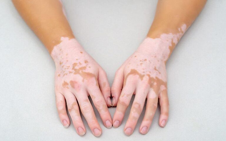 vitiligo treatment in chandigarh