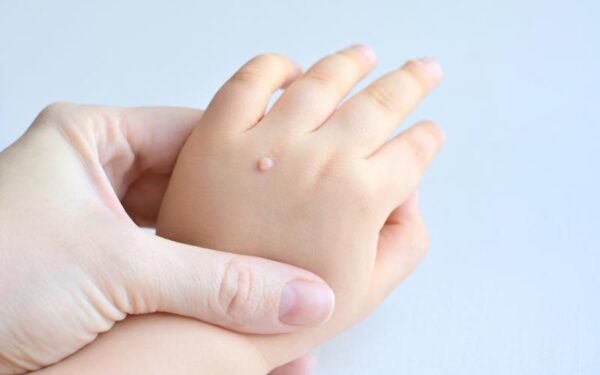 Warts in Children - Dr. Walia's Skin And Laser Clinic